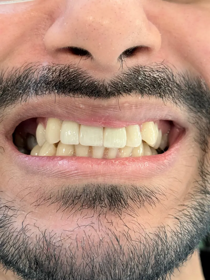 After: Front teeth, smiling, front view