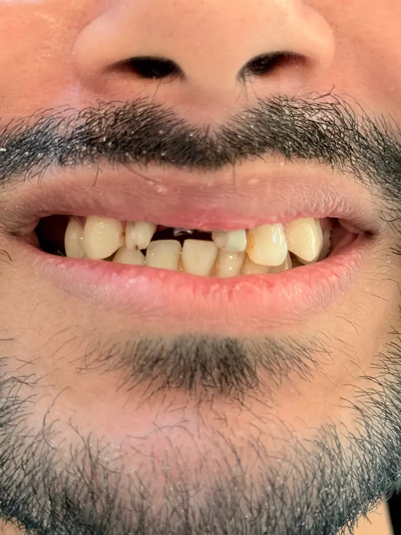 Before: Front teeth, smiling, front view