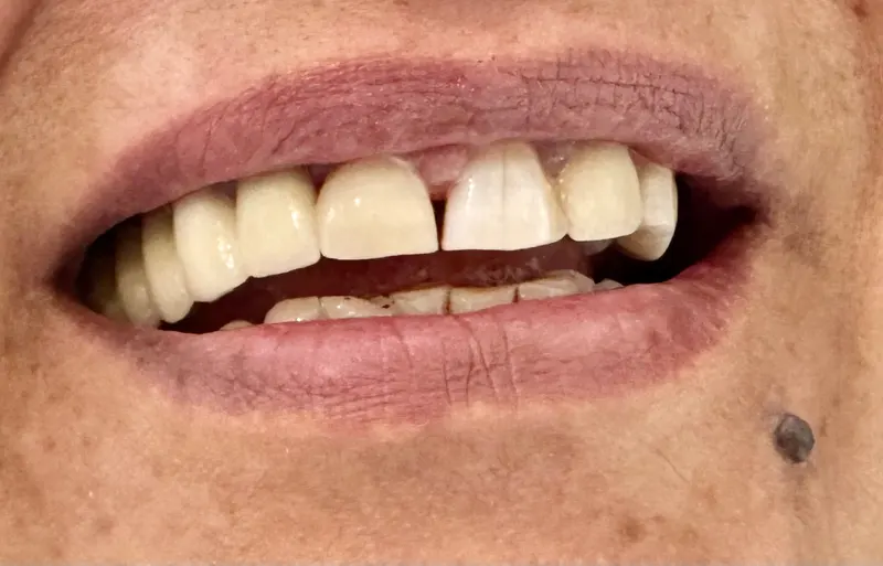 After: Front teeth, close-up of the lips, front view