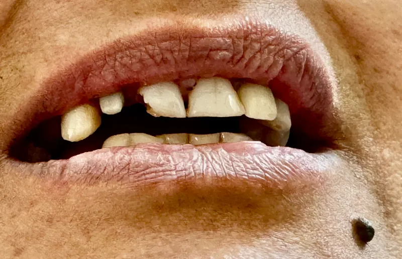 Before: Front teeth, close-up of the lips, front view