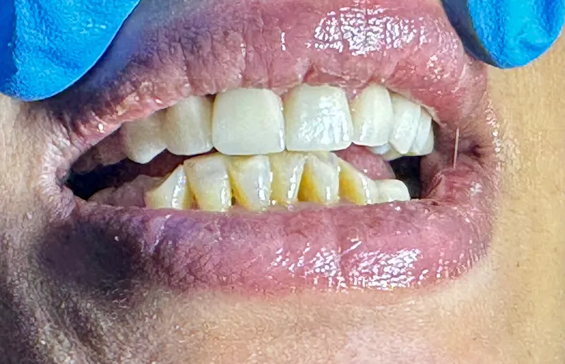After: Upper and lower front teeth, front view
