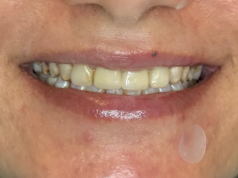 After: Upper front teeth, smiling, front view