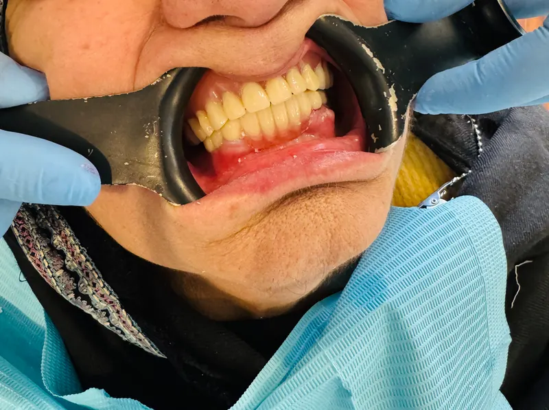After: Upper and lower jaws with a cheek retractor, front view