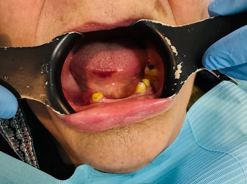 Before: Upper and lower jaws with a cheek retractor, front view
