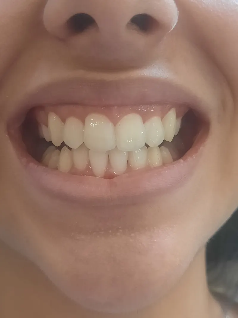 After: Front teeth, front view