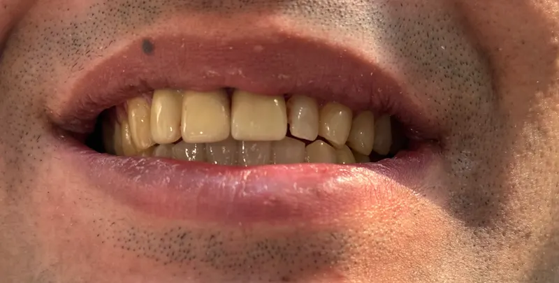 After: Front teeth, smiling, front view