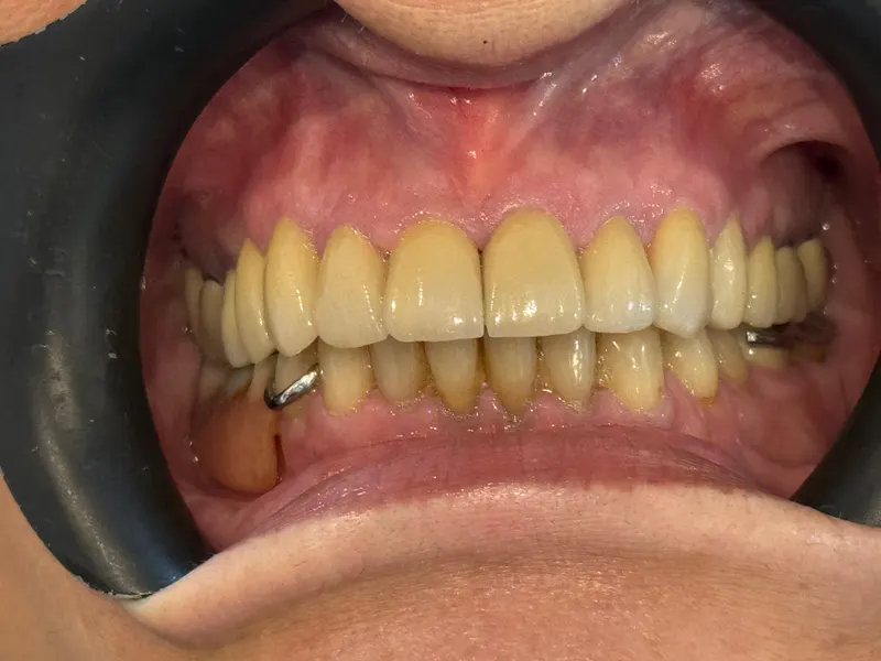 After: Front teeth with a cheek retractor, front view