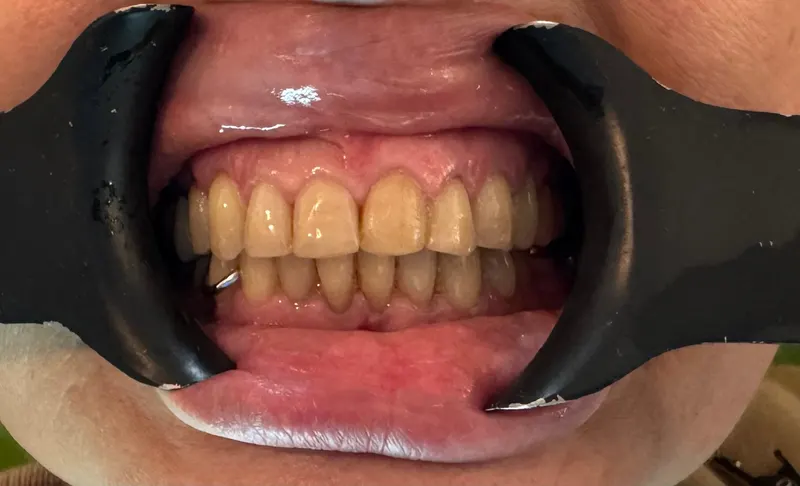 Before: Front teeth with a cheek retractor, front view