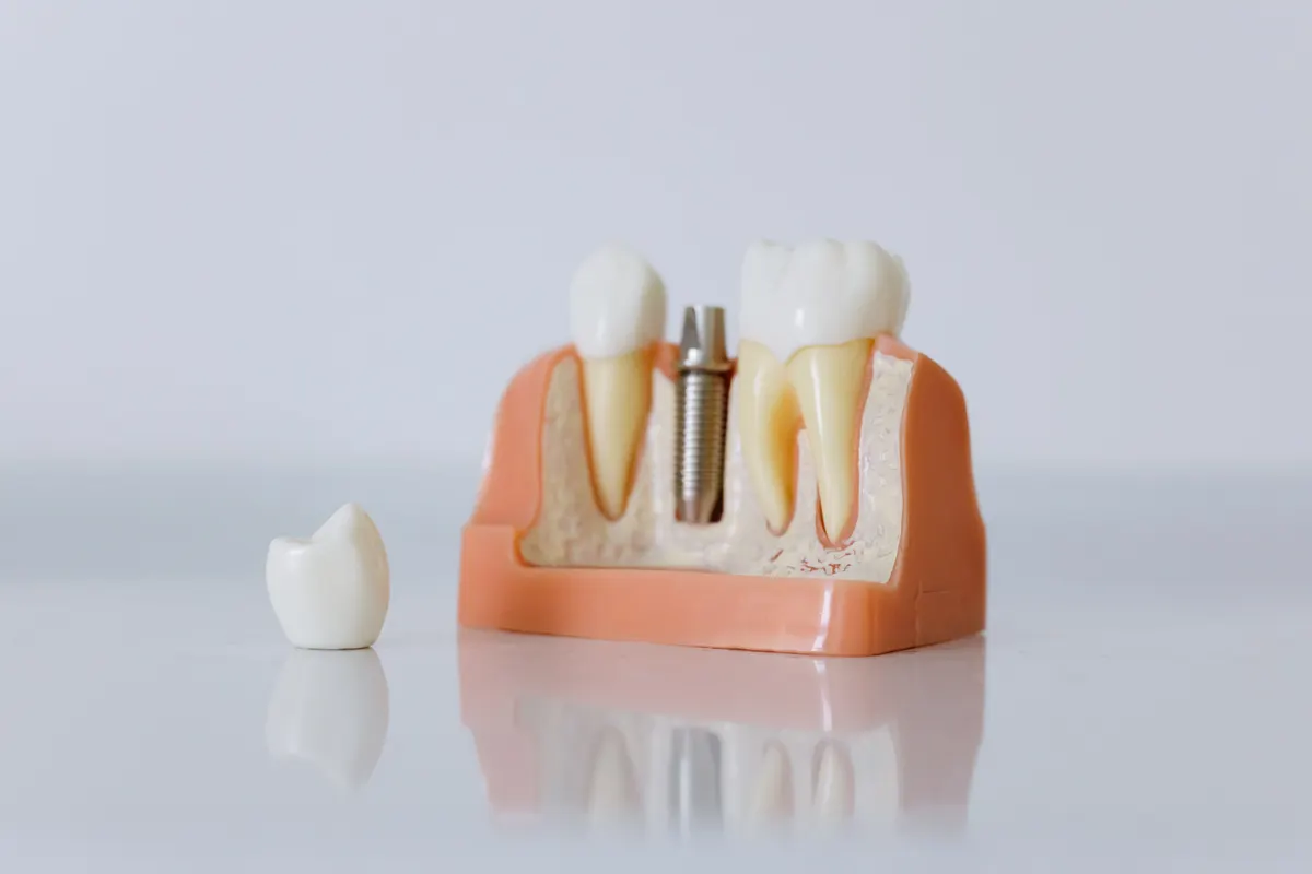 A cut-away model of a dental implant in the jaw, with its crown beside it.